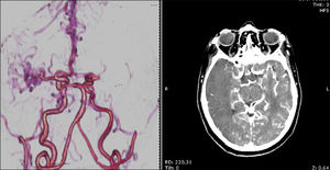 Angio-TC de cerebro.
