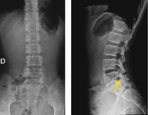 Se observa imagen sugerente de lisis a izquierda. Se complementa estudio con TAC.