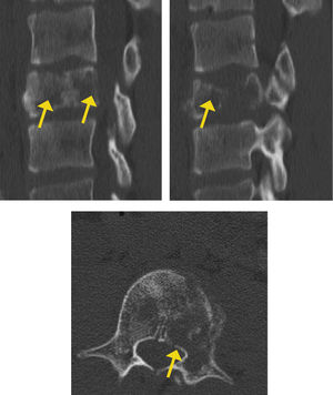 TAC: lesión lítica, con compromiso mayor del 50% del cuerpo vertebral y con colapso de éste. Destaca además afectación de cortical corporal.