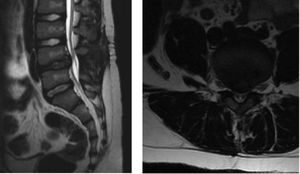 Estudio imagenológico de scanner compatible con vertebra limbus, con ocupación del 50% del canal.