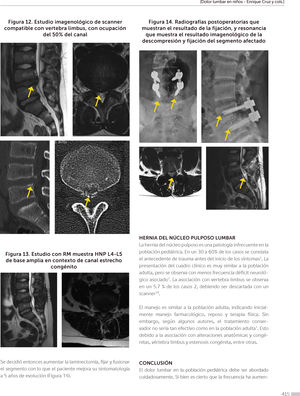 Estudio con RM muestra HNP L4-L5 de base amplia en contexto de canal estrecho congénito.