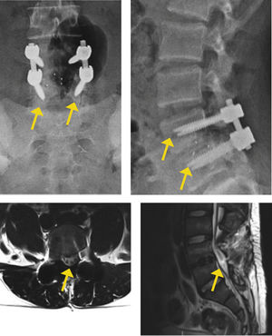 Radiografías postoperatorias que muestran el resultado de la fijación, y resonancia que muestra el resultado imagenológico de la descompresión y fijación del segmento afectado.