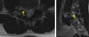 Edema pedicular y lisis de pars izquierda.