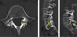 Lisis bilateral en L5.