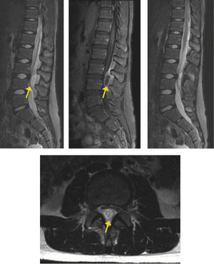 Estudio con RM muestra ocupación del canal medular por colección purulenta a nivel L3-L4, espontáneamente hiperintensa en T2, e hipointensa en T1, con realce en anillo a la administración de contraste, compatible con absceso.