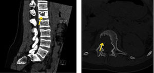 Estudio con TAC. Imagen lítica en cuerpo vertebral con destrucción cortical.