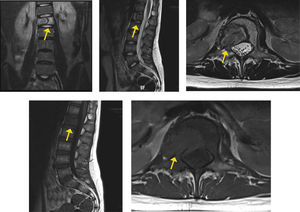 Estudio con RM. Lesión hiperintensa en T2, hipointensa en T1, con extensión a partes blandas circundantes. Con afectación de bajo grado del canal. Destaca ausencia de colapso significativo del cuerpo vertebral afectado.