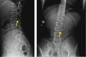 Se observa destrucción del pedículo izquierdo en estudio radiológico, con pérdida de altura a nivel de plataforma inferior y superior de L3.