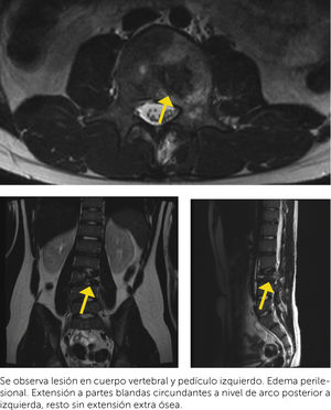 RNM T2. Se observa lesión en cuerpo vertebral y pedículo izquierdo. Edema perilesional. Extensión a partes blandas circundantes a nivel de arco posterior a izquierda, resto sin extensión extra ósea.