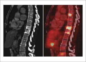 RMN–Tumor vertebral con Hipo señal en T1 e Hiper señal en T2.