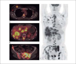 PET–CT con metástasis hepáticas y vertebrales.