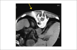Biopsia por punción bajo TAC. La flecha indica dirección del trocar de biopsia.