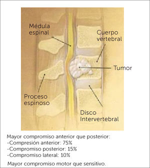 Compromiso Neurológico Nota: Tomado de Boos, N. and Aebi, M. (Ref.1).