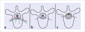 Clasificación de la compresión medular, según AOSpine. Se evalúa en corte transversal T2 de RMN en nivel de máxima compresión medular. (a) Grado 0=Tumor intra óseo; Grado 1a=Contacto epidural sin deformación del saco tecal; Grado 1b=Deformación del saco tecal sin contacto medular; Grado 1c=Contacto medular sin compresión. (b) Grado 2=Compresión medular con presencia de LCR peridural. (c) Grado 3=Comp. medular sin LCR visible. Nota: Tomado de Vialle LR. (Ref.10).