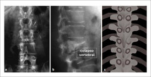 Colapso Vertebral Tumoral L3–Imagen y diagrama de “Buho Tuerto” pedículo izquierdo de L3.