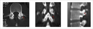 Imagen de TAC tumor arco posterior. Las flechas rojas indican la localización de un osteoma osteoide facetario izquierdo.