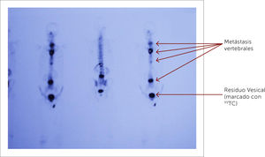 Cintigrama óseo con múltiples metástasis vertebrales.