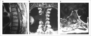 Lesión tumoral en RMN con invasión paravertebral e intraraquídeo. a. Tumor intrarraquídeo; b. Compromiso paravertebral derecho, corte coronal; c. Compromiso paravertebral derecho, corte transversal.