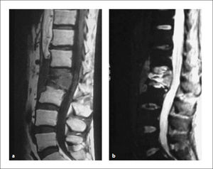 RMN–Tumor vertebral con Hipo señal en T1 e Hiper señal en T2. La imagen a) muestra imagen de T1 y b) T2. Nota: Tomado de Boos, N. and Aebi, M. (Ref.1).