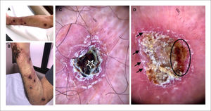 Imágenes clínicas y dermatoscópicas (A) y (B) Múltiples úlceras y nódulos con centro costroso y exudativo asociado eritema perilesional en patrón esporotricoide. (C) Dermatoscopía con costra hemática central (estrella) sobre fondo eritemato-violáceo, patrón vascular no en foco sobre área rojo-lechosa (zona con aumento). (D) Áreas amarillo-anaranjadas sin estructura (círculo negro) y descamación periférica superficial (flechas negras).