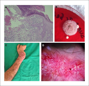 Imagen histopatológica, cultivo e imagen clínica post tratamiento (A) Epidermis con áreas ulceradas, infiltrada por polimorfonucleares formando abscesos y dermis con infiltrado inflamatorio mixto y células gigantes multinucleadas de tipo cuerpo extraño. Magnificación 100x. (B) Cultivo en agar sabouraud-dextrosa con crecimiento de colonia color rosado-cremosa, se observa crecimiento radial periférico. (C) Lesiones a los 2 meses post-tratamiento con disminución importante de tamaño, eritema y exudado y (D) dermatoscopía con patrón vascular de fondo no en foco y ausencia de costra hemática central.