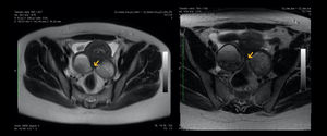 Imagen RM pelvis Se muestra la existencia de un nódulo endometrósico retrocervical a nivel del torus uterino, que se extiende hacia la cara anterior del recto superior, comprometiendo la capa muscular externa del recto (Flecha amarilla). Además se observa la presencia de un quiste endometriosico en vada ovario.