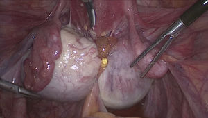 Imagen de la visión quirúrgica durante la inspección laparoscópica Se observa un extenso compromiso del compartimento posterior de la pelvis, con un nódulo endometriosico retrocervical que infiltra la cara anterior del recto superior. El intestino se encuentra adherido a la pared posterior del útero, entre ambos ovarios aumentados de volumen por endometriosis ovárica.