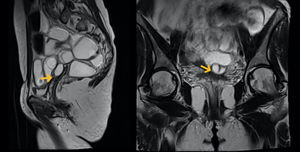 Imagen de RM pelvis Se muestra la presencia de irregularidad a nivel de ambos fórnices vaginales, mayor a derecha, que puede corresponder a un implante endometriosico que se extiende contactando la pared anterior del recto sin infiltrarla (Flecha amarilla). Se observa además una lesión quística de 12mm de aspecto foliclar y una lesión quística de 22×10mm que puede corresponder a un quiste de inclusión peritoneal.