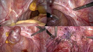 Imagen de la visión quirúrgica durante la inspección laparoscópica y luego de finalizar la resección de la endometriosis (A y B) Imagen de la visión quirúrgica durante la inspección laparoscópica, donde se observa implantes de EIP localizados sobre el trayecto de ambos uréteres y nervios hipogástricos, y una extensa fibrosis que compromete lateralmente la vagina. (C) Lesión quística sobre la cúpula vaginal. (D) Visión de la peñvis al finalizar la cirugía, destacando la sutura sobre la cúpula vaginal, sutura vesical, ramas del nervio hipogástrico a derecha y ambos ureteres libres de fibrosis cicatricial.