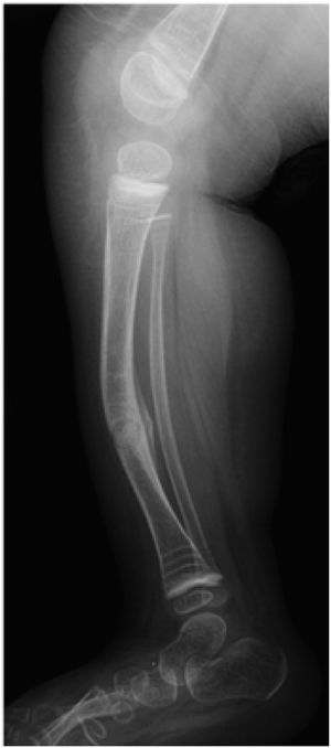Tibia.