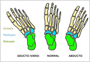 Deformidades del pie en el plano antero-posterior (AP). Desplazamiento a medial o lateral del antepié (metatarsos) en relación al retropié.