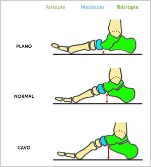 Deformidades del pie en el plano lateral con carga. Cambios en la altura del arco plantar (flecha roja). Colapso y verticalización del astrágalo en pie plano. Caída del antepié con respecto al retropié en pie cavo.