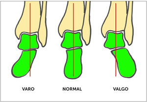 Deformidades en el plano coronal del retropié con carga (proyección radiográfica de Saltzman). Desviación del talón con respecto al eje de carga de la tibia (en rojo).