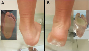 Pie plano-valgo flexible. A: valgo del retropié y ausencia de arco plantar con carga. B: Se alinea el retropié y se evidencia el arco plantar al ponerse en punta de pies.