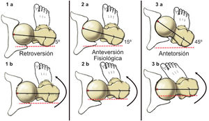 Relación entre ángulo de anteversión del cuello del fémur y la rotación interna de la cadera. La línea sólida negra representa el eje del cuello femoral. La línea punteada roja corresponde al plano horizontal. 1. En la retroversión, el eje del cuello es casi paralelo al plano horizontal (a), por lo que la rotación interna es mínima (b). 2. En la anteversión femoral fisiológica, el cuello femoral está inclinado 15° hacia adelante (a). Esto permite una mayor rotación interna de la cadera, que lleva a la punta del pie ligeramente hacia medial. 3. En la antetorsión, el cuello femoral está muy inclinado respecto a la horizontal (a), por lo que la rotación interna es mayor, lo que deja al pie apuntando muy hacia medial (b).
