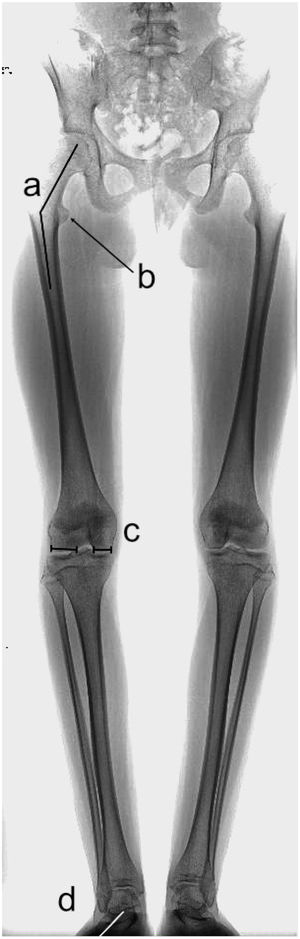Telerradiografía de extremidades inferiores en un paciente con deformidad torsional. A) Se observa un aumento aparente del ángulo cérvico-diafisiario del fémur. B) El trocánter menor se ve muy prominente. C) Hay una asimetría en el ancho de los cóndilos femorales. Todo lo anterior debido a antetorsión femoral. D) Nótese que ambos pies apuntan hacia afuera, lo que sugiere torsión tibial externa.