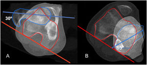 TAC para estudio de torsión femoral y tibial en un paciente de 14 años de edad. Se ha dibujado contorno del cuello femoral (azul) y de los cóndilos femorales (rojo). La torsión en este caso es de 30°. B) Estudio de torsión tibial. En azul se dibuja contorno de la pierna a nivel de articulación tibio-peronea distal. Se observa una torsión tibial externa de 65°.