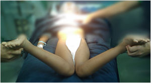 Paciente de 7 años con antetorsión severa del cuello del fémur. Nótese que, en posición supina, logra rotar sus caderas más allá de 90°, logrando elevar las piernas por sobre la horizontal.