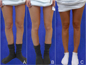 Paciente de 14 años con torsión tibial externa severa. A) Con las rodillas de frente, se aprecia que sus pies apuntan hacia afuera. B) Al pedirle que junte los pies, las rodillas rotan hacia interno. C) Resultado después de corrección quirúrgica de ambas piernas.