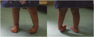 Paciente de 2 años de edad con recidiva de pie bot tras tratamiento con método Ponseti, producto de no uso de férula de mantención. Gentileza de Dra. Ximena Agurto, Talca.