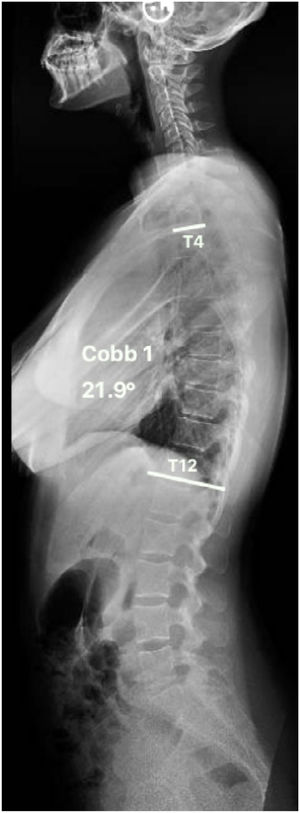 Radiografía de columna total en proyección lateral. Se observa una cifosis normal medida según método de Cobb entre la plataforma superior de T4 y la plataforma inferior de T12.