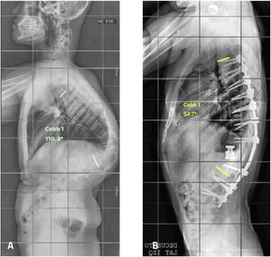 Radiografía pre y postoperatoria de paciente con cifosis congénita. A: Radiografía preoperatoria de paciente de 14 años con diagnóstico de cifosis congénita, en que se observa un defecto de formación de vertebra T11 lo que produce una cifosis de 110°; B: Radiografía postoperatoria en que se observa vertebrectomía de T11, lográndose una cifosis de 52° con un balance sagital adecuado.