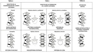 Clasificación de cifosis congénita. Clasificación de cifosis congénita según McMaster MJ, Singh H. Natural history of congenital kyphosisand kyphoscoliosis. A study of one hundred and twelve patients. J Bone Joint Surg Am 1999;81:1367–83.