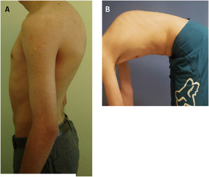 Aspecto clínico de paciente de género masculino, 17 años de edad con Enfermedad de Scheuermann. A: En su perfil sagital se observa la cifosis torácica aumentada; B: Al realizar el test de Adams se observa una clara cifosis angular.