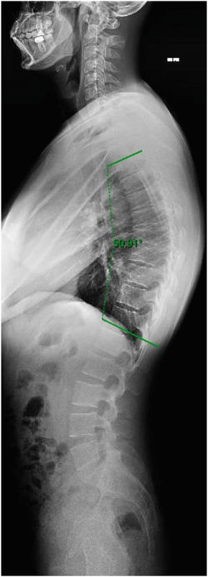 Radiografía de paciente de 16 años con enfermedad de Scheuermann. Se observa una cifosis de 50° con acuñamiento de vertebras T7, T8 y T9 e irregularidad de placas vertebrales en estos niveles.