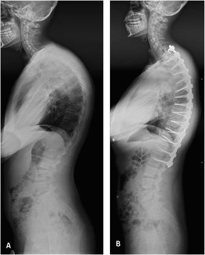 Tratamiento quirúrgico de enfermedad de Scheuermann severo. A: Radiografía de columna total lateral en paciente de 16 años, en que se observa una Cifosis de Scheuermann de 80°; B: Aspecto radiológico postoperatorio en que se realizaron osteotomías de Smith Petersen asociados a una artrodesis por vía posterior instrumentada.