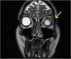 Imagen de corte frontal de RM craneal donde se visualiza masa heterogénea que no parece afectar a estructuras óseas adyacentes.