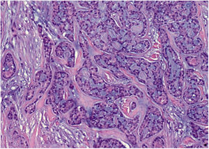 Proliferación celular epitelial de patrón cribiforme con material mucohialino en las pseudoluces. (Tinción con Hematoxilina-Eosina. 10X).