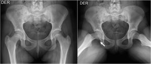 Epifisiolisis leve y estable. Mujer de 12 años que consultó por dolor inguinal derecho de 1 mes de evolución, con capacidad de marcha. Se observa mínimo desplazamiento de cabeza femoral derecha en proyección Lauenstein, compatible con epifisiolisis estable de cadera derecha.