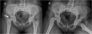 Epifisiolisis severa e inestable. Mujer de 12 años que consultó por dolor muslo derecho de 1 mes de evolución, hace 2 días con dolor más intenso que le impide la carga. Se observa severo desplazamiento de cabeza femoral derecha en ambas proyecciones, compatible con epifisiolisis inestable de cadera derecha.
